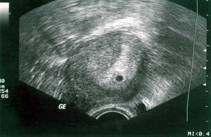 признаки беременности две недели после зачатия